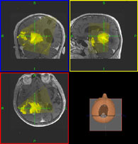 Brain Navigation