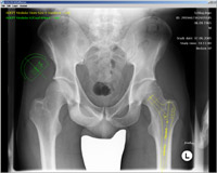 Orthopädie Planungssoftware